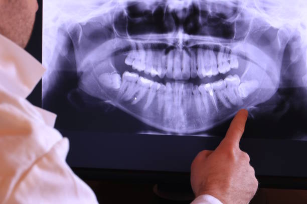 Best Emergency Dentist for Lost Fillings or Crowns in Mount Vernon, MD